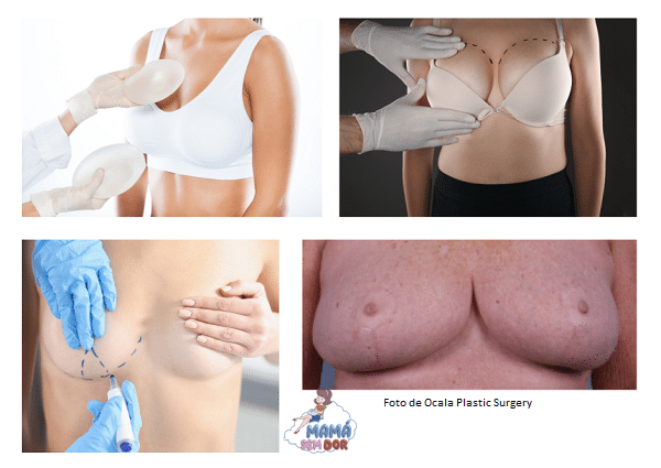 Cirurgias mais comuns no seio da mulher: prótese de silicone e redução de mamas.