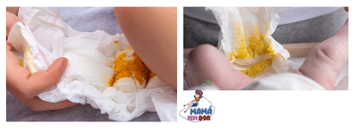 Fralda com cocô normal de bebê recém-nascido, amarelo mostarda com grumos.
