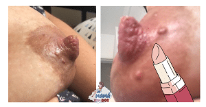Mamilo (bico do peito) amassado após mamada, o chamado mamilo em “ponta de batom”.