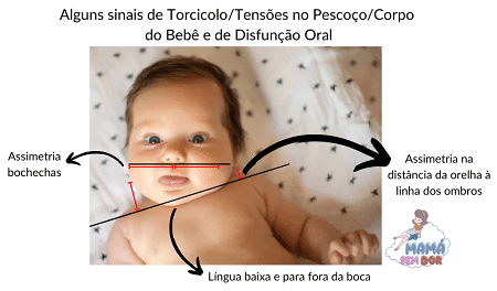 Bebê com torcicolo congênito, fica com a cabeça mais virada para o mesmo lado.
