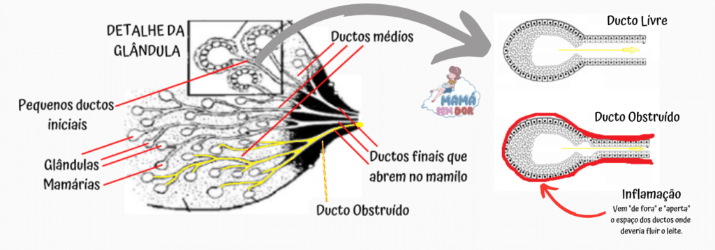 Desenho esquemático de uma obstrução ou bloqueio de ducto lactífero, mostrando leite represado dentro dos ductos e a inflamação que diminui o espaço onde o leite precisa fluir.