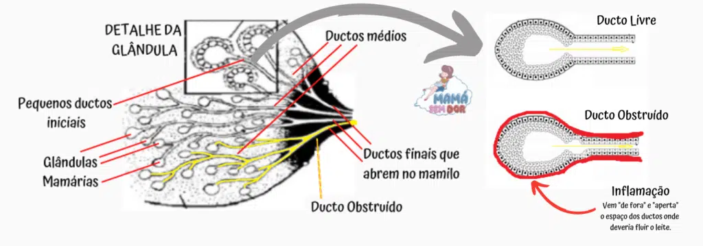 Desenho esquemático de uma obstrução ou bloqueio de ducto lactífero, mostrando leite represado dentro dos ductos e a inflamação que diminui o espaço onde o leite precisa fluir.